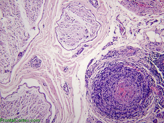 Necrotizing vasculitis involving epineurial arteriole